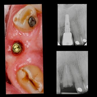 neil implant case nov 22 3