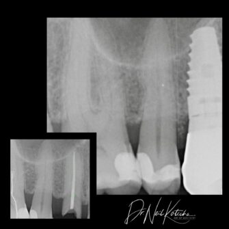 nk implant sept 24 2