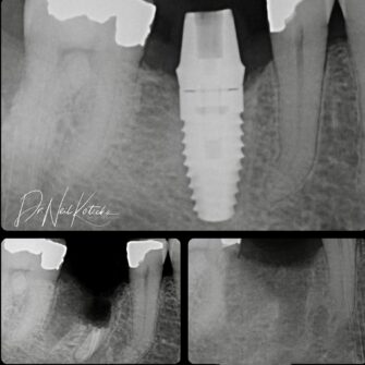 nk implant jan 25 3